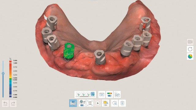 A.I. Scanbody & Abutment Matching