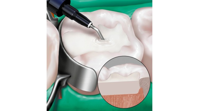 Venus® Bulk Fill Application Primary Teeth