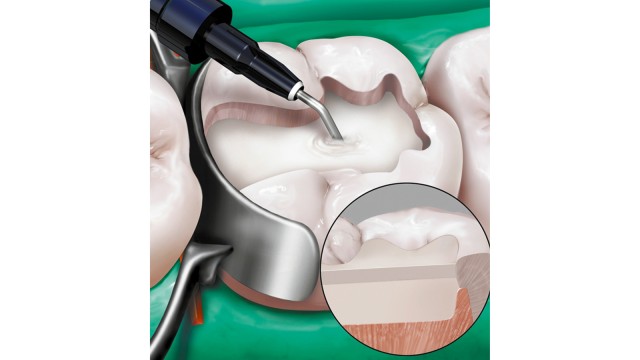 Venus® Bulk Fill Application Adult Teeth